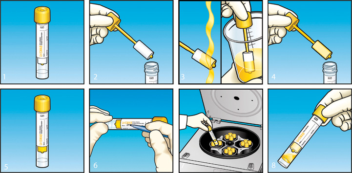 tampon de noroi pentru prostatită infectie urinara joasa
